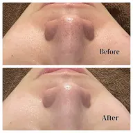 minimo限定価格！毛穴吸引×ヒト幹細胞ラジオ波！ハイドラ毛穴洗浄🍂