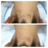 限定価格✨レディース全身脱毛❇️顔VIO含む