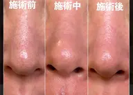 毛穴角栓洗浄吸引60分 【men’s】もok          13200→6600