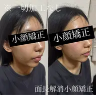 小顔矯正