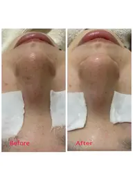 ポアレスラボ開発！毛穴洗浄後ダメージ肌にビタミン誘導体VCエチル配合美容液をエレクトロ導入⭐️