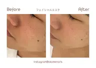 【フェイシャル】【メンズ】+肌質改善パーソナルパック🧘🏻