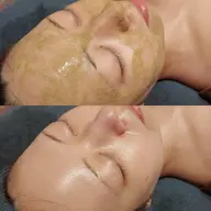 初回【ニキビ・毛穴ケア】韓国肌管理☆ohlハーブピーリング剥離なし🌿