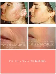 ドイツのエステ☆美容外科、皮膚科でも大人気☆グリーンピール5Days