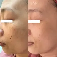 【4月ミニモ限定】シミケアトリートメント10分当て放題