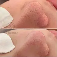 《9月限定ミニモ価格》頑固な毛穴を綺麗にするコース