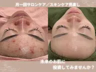 【ニキビ/黒ずみ/肌質改善】陶肌トリートメント　ハーブピーリング