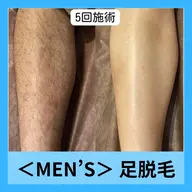 【メンズ脱毛】足の脱毛1回2,500円　足の甲・指脱毛付き