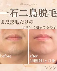 【急な予定にも対応】メンズひげ脱毛　鼻下/顎/顎下30分