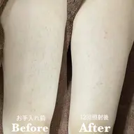 【清潔感UP】メンズ ひざ下脱毛 初回 ¥1,980