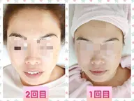 フォーカスネオ  次世代エステマシーン🌟｡:*