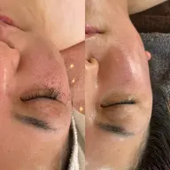 若くみえたい方に Lit プログラム導入３回コース（ヒト臍帯由来幹細胞上清液）