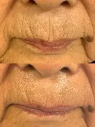 【艶玉】3種のフレッシュ幹細胞＋国産ハーブピーリング