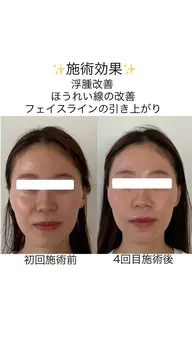 全身整体+小顔矯正+美容鍼