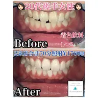 《初回限定》プレミアムセルフホワイトニング★最短で白くなりたい方★2来店コース　合計70分照射