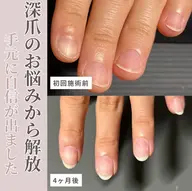 第2期【モニター募集】深爪矯正/自爪育成【ハンド】