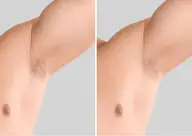 メンズ☆全身脱毛【荻窪】