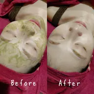 初回【ニキビ毛穴ケア】韓国肌管理☆ohlハーブピーリング剥離なし&デコルテマッサージ付