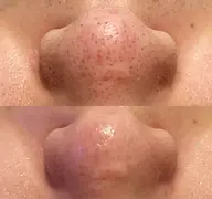 【ハイドロスプラッシュ】 いちご鼻/黒ずみ/角栓/毛穴撃退ケア