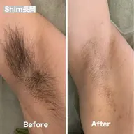 ミニモ限定メニュー脇脱毛