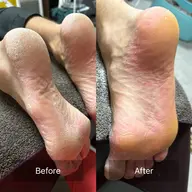 素足! 気になる足の匂い 魚の目・タコ・ガチガチかかとに足の角質ケア 60分¥4,950