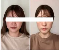 小顔効果抜群！【エンドリングフェイシャル®︎ 】スタンダードコース