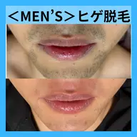 【男性脱毛人気No.1】メンズヒゲ脱毛　面倒なヒゲ処理stop