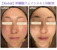 肌力UP✨フェイシャル75分(レストセルトリートメント)