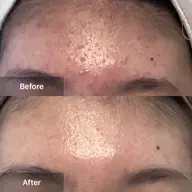 🌿ニキビハーブピーリング✨【剥離あり】【毛穴洗浄】【VC美容液】ニキビ/ニキビ跡/黒ずみ/水光肌/毛穴ケア/白ニキビ