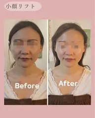 【限定価格¥2,200/3名限定募集】小顔リフト　顎下二重顎、フェイスライン輪郭、お顔のむくみに◎限定3名様募集中です。
