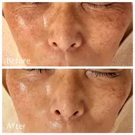 【NEW即効性最強ピーリング】水光ピール+美容液導入 50分