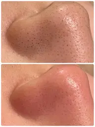 【新規限定】期間限定期間★毛穴エクストラクション