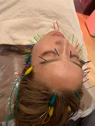 気になる毛穴開きもごっそり落とす🔥ハイドラ＋美容鍼🪡