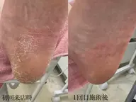 本格足裏角質ケア