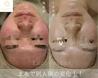 《顔◆最強ニキビケア》ハーブピーリング×アクネ菌ケア×鎮静×毛穴洗浄