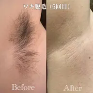 【ワンコイン】ワキ脱毛(レディース・メンズ)¥500