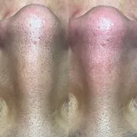 🌱ミニモ限定。毛穴エクストラクション2回目以降