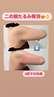 初回 お好きな箇所2カップ(下っ腹、内もも、二の腕、ふくらはぎにおすすめ)