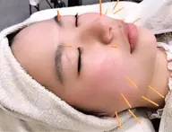 人気No. 2👑美容鍼➕潤肌パック