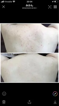 平日限定‼️ボディーハーブピーリング（剥離なし）※ハイドラ付🌿モニター募集　背中or二の腕orお尻orデコルテなど