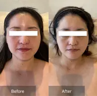 整形級小顔&ツヤ肌🍋2cc