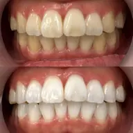 【しっかり効果を実感したい方へ🦷】8分照射×6回💎漂白剤不使用のホワイトニングジェルで安全に白い歯へ❗