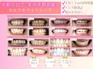 セルフホワイトニング(9分×2セット)¥3980→¥500