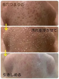 【話題沸騰！ニキビ•皮脂•テカリ】ハイパワー毛穴洗浄　全顔