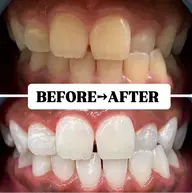 【当日に回数券ご購入の方】初回無料★美白ホワイトニング20分×2回照射が無料✨