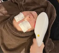 🎓ミニモ学割U24｜お顔光脱毛（毛穴ケア付き） ¥3,980