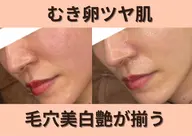 【韓国肌管理🇰🇷卒業・入学前に】ララピールで透明感UP！くすみニキビ乾燥肌荒れ◎