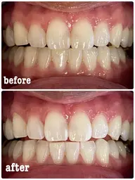 先着5名限定!自然に白くなるセルフホワイトニング✨ 今だけ《照射1回サービス》