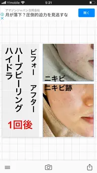 今月限定‼️ブライダルプラン39800👰💒✨最高級ハーブピーリング🌿顔首デコルテ、うなじ、背中、腕　部位変更可✨
