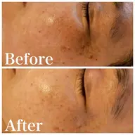 【再来様専用】ハーブピーリング剥離あり